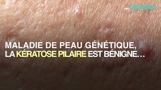 De petits boutons sur vitre peau annoncent peutêtre une kératose pilaire [upl. by Akenet15]