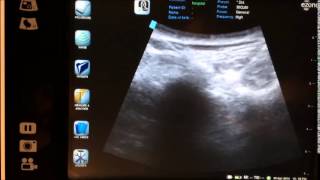 ultrasound guided bilateral SI joint injection  sacroilliac joint injection [upl. by Hsetim]