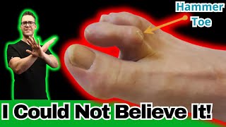 How to Fix Hammer Toes at Home Overlapping amp Crossover Toes [upl. by Ecnerewal]