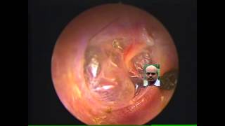 Retracted ear drum seen bulging on valsalva [upl. by Dnalevelc912]