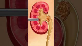 👶 Kidney stones procedure 👶  animationshorts shortsfeed youtubeshorts viralshorts [upl. by Nan]