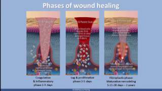 Understanding Scar Tissue [upl. by Aicillyhp]