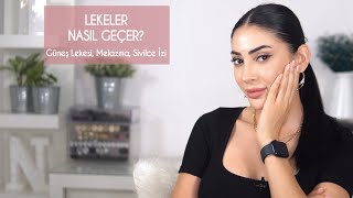 Lekeler Nasıl Geçer │ Güneş Lekeleri ve Sivilce İzleri İçin Öneriler [upl. by Tnelc]