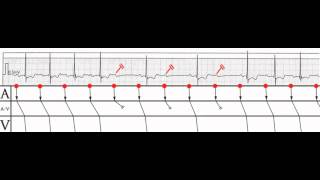 Kardioblog  AV bloky 21 high grade Mobitz I vagotonní [upl. by Halak]