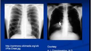 Chest xray interpretation  Lung consolidation and main causes [upl. by Josy]