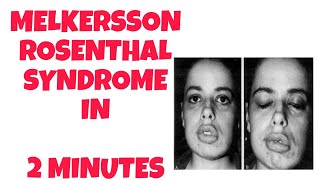 melkersson Rosenthal syndrome  2 minutes knowledge  syndrome of head and neck [upl. by Anela]