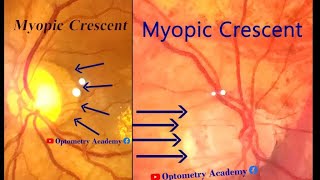 Myopic Crescent Fundus video [upl. by Longo]