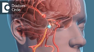 What is the recovery time for Brain Aneurysm  Dr Tejus MN Rao [upl. by Eiddal]