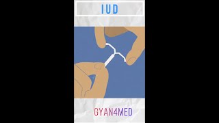 What is an IUD [upl. by Suneya]