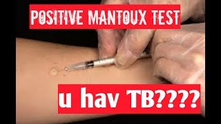 positive mantoux test tuberculin test positive result means [upl. by Krishnah]