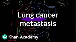 Lung cancer metastasis  Respiratory system diseases  NCLEXRN  Khan Academy [upl. by Binnings]