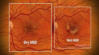 Macular Degeneration  an animated explanation [upl. by Ynattyrb]