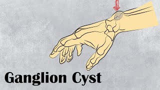 Ganglion Cyst  Surgery Short Cases [upl. by Reinhardt]