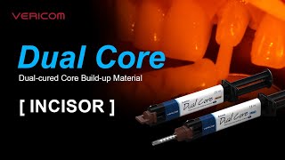 Dual Cured Core Build up Material Incisor [upl. by Letsyrhc]