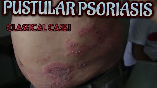 Dermatology  Pustular Psoriasis  Dr Suchana Marahatta  नेपालीमा [upl. by Tresa]