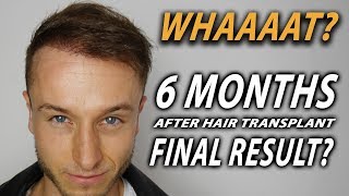 Hair Transplant End Result by the 6 MONTHS not 12 MONTHS [upl. by Nedlog]