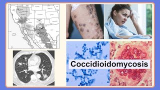 coccidioidomycosis [upl. by Shiverick]