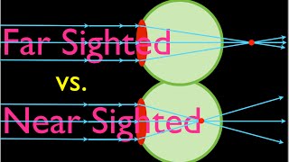 Farsighteness vs Nearsightedness An Explanation [upl. by Riley]