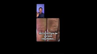 Microcirurgia de varizes resultados espetaculares [upl. by Judus360]