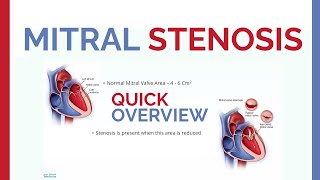 TET TALKS 6 MITRAL STENOSIS AND PREGNANCY [upl. by Coffin]