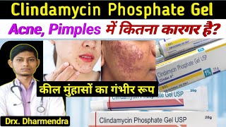 Clindamycin phosphate gel usp  clindamycin phosphate gel  clindac a gel how to use [upl. by Dickey]