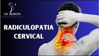 RADICULOPATIA CERVICAL [upl. by Ymmas]