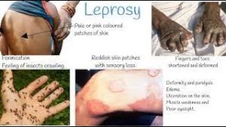 Leprosy  leprosy treatment  Leprosy pathology  hensens disease  leprosy disease [upl. by Frech415]