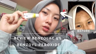 BENERAN NYEMBUHIN JERAWAT  Review Benzolac 5 Benzoyl Peroxide [upl. by Lindgren202]