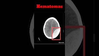 Brain Hematoma CT Brain  EDH  SDH shorts hematoma radiology brainhaemorrhage [upl. by Jessamyn]