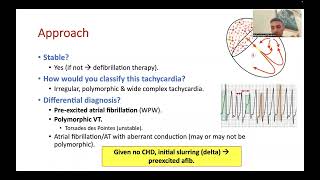 WPW syndrome amp SVT management [upl. by Bartolome]