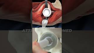 Direct Anterior Approach Hip Replacement [upl. by Hatnamas911]