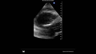 POCUS tamponade [upl. by Ecerehs633]