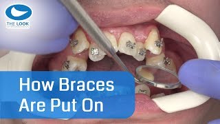 How braces are put on  AMAZING   Now with 12 month  Progress  httpsgoogljXaY15 [upl. by Ettenav]