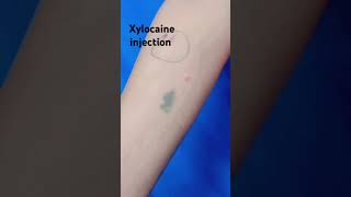 xylocaine injection viralshort video [upl. by Nilhsa]