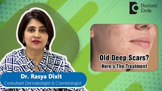 Treatment Of Deep Old Acne Scar for Clear Skin acne pimple  Dr Rasya Dixit  Doctors Circle [upl. by Kannav]