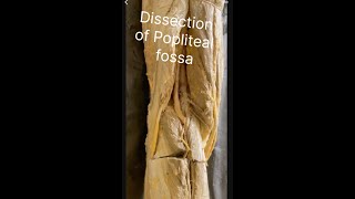 Popliteal fossa Dissection of popliteal fossa Anatomy of popliteal fossa Contents popliteal fossa [upl. by Bittencourt94]