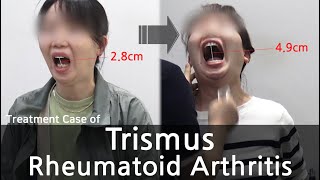 Trismus  Rheumatoid Arthritis  개구장애  류마티스 관절염 치료사례 [upl. by Elboa757]