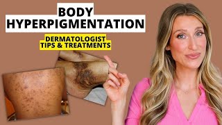 Dermatologist Explains Body Hyperpigmentation What Causes It Best Treatments Prevention amp More [upl. by Akihsan]