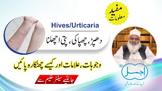 Chapaki چھپاکی  Dhappar دھپڑ  HivesUrticaria Causes Symptoms and Herbal Treatment in Urdu [upl. by Laroy]