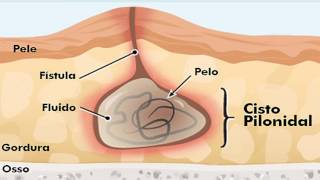 Cisto Pilonidal [upl. by Lamraj]