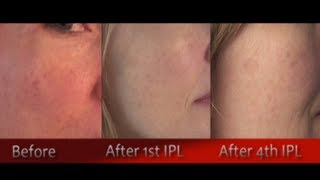 IPL Photofacial Review After 4 Treatments  Before amp After [upl. by Button]