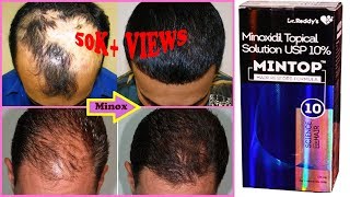 Minoxidil Mintop 10  Product Review [upl. by Yadseut904]