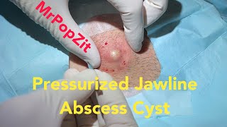 Pressurized Jawline Abscess Cyst Squirting cyst pop with surprising large sac dissection on neck [upl. by Yarod]