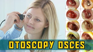 OTOSCOPY OSCEs  PLAB Image Reference [upl. by Alaster48]