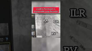 Leadless Pacemaker amp Implantable Loop Recorder on fluoroscopy heart Cardiology [upl. by Ettecul568]