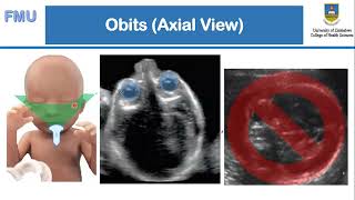 Fetal Anomaly Scan How To  Mr S Chigayo [upl. by Japha]