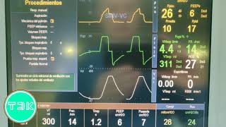 GE Engstrom Carestation Respiratory Ventilator [upl. by Atinihs570]