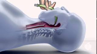 ACLS Using an LMA [upl. by Nerraw938]