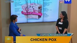 Good Morning Kuya Chicken Pox  Symptoms and Treatment [upl. by Brooks]