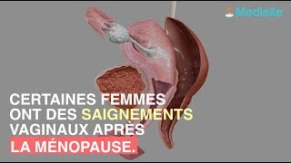 Saignements à la ménopause  attention au cancer de lendomètre [upl. by Trix]